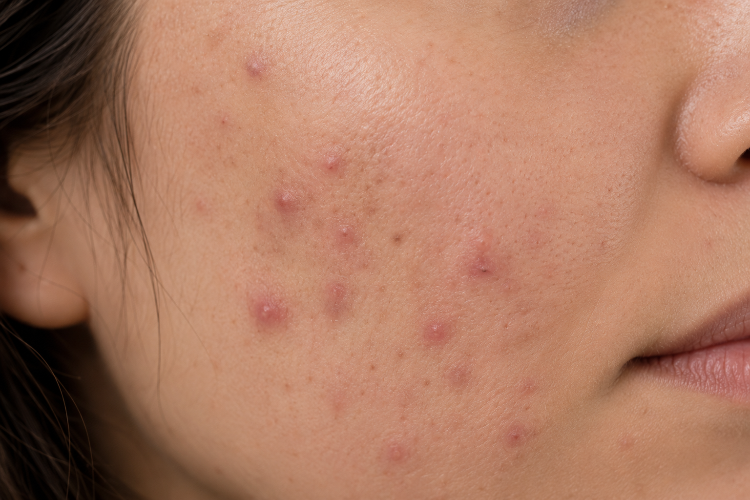 Adult Acne