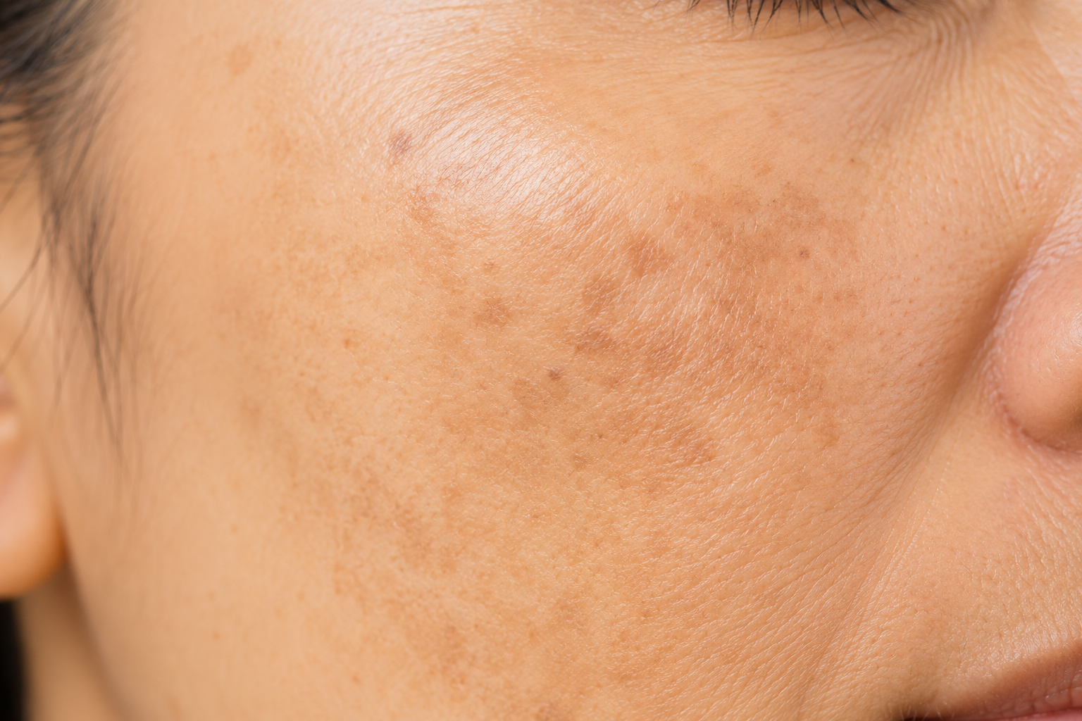 Pigmentation
